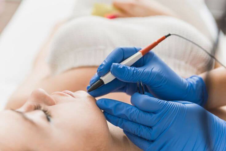 An electrologist using electrolysis probe on upper lip