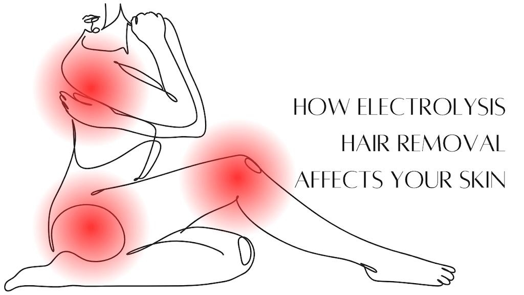 A picture with the drawing of a female figure with red dots around her skin and the text How Electrolysis Hair Removal Affects Your Skin on the right