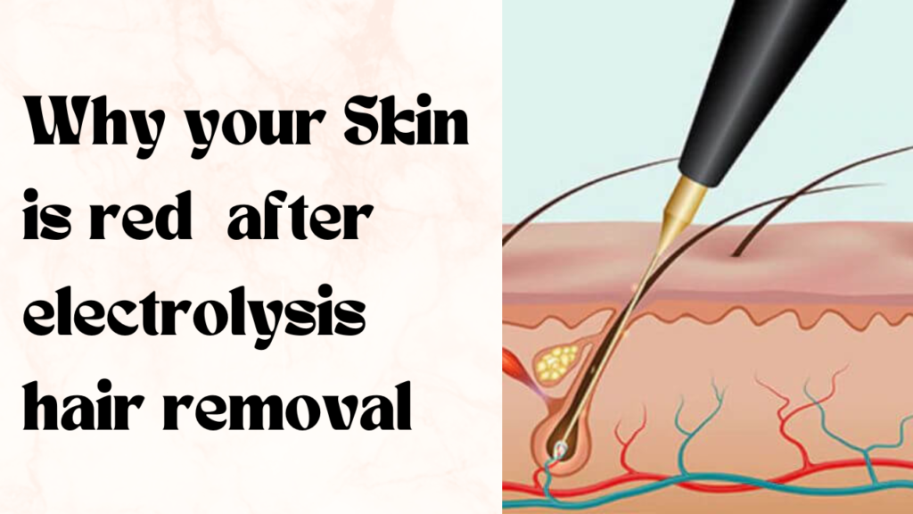 A text of Why your Skin is red after electrolysis hair removal and another picture of diagram of hair follicles